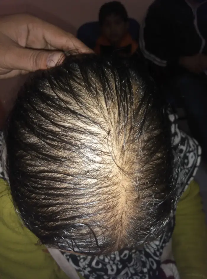 Female Pattern Baldness case 1 before treatment